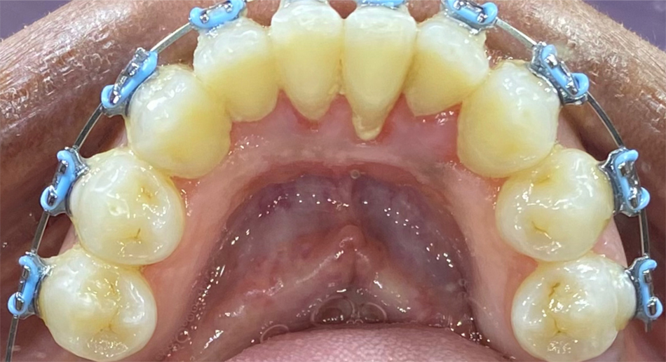 strait teeth with braces