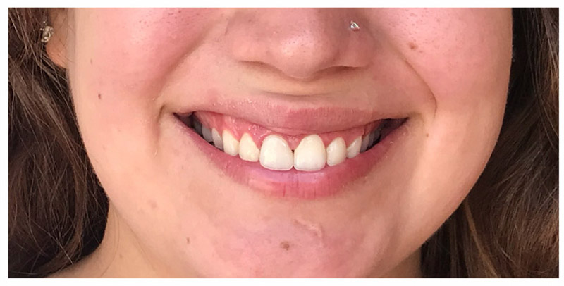 Crowns cosmetic dentistry