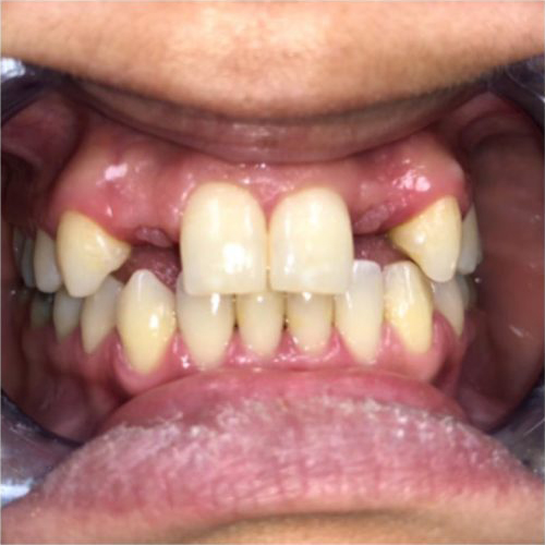 front-teeth-replacement2-before.jpg