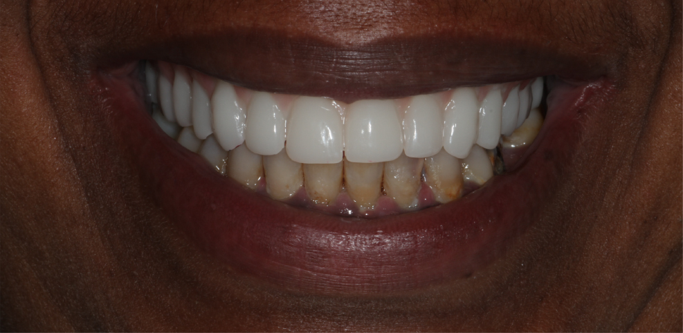 implant-supported-fixed-teeth-denture-after.jpg