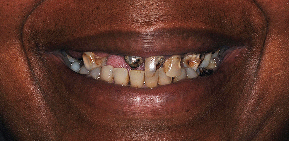 implant-supported-fixed-teeth-denture-before.jpg