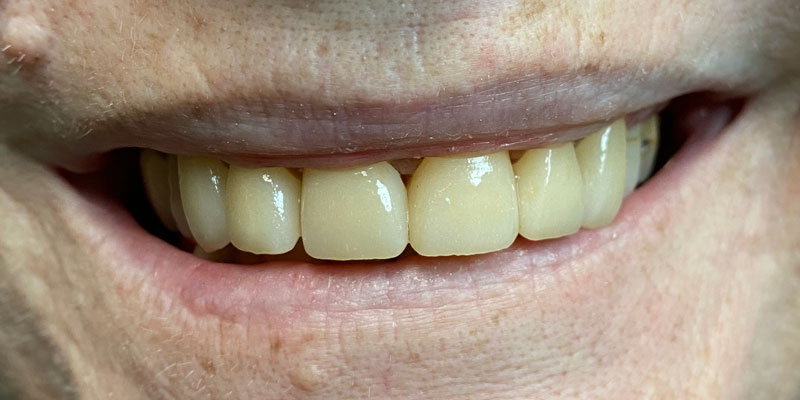 natural looking cosmetic crowns