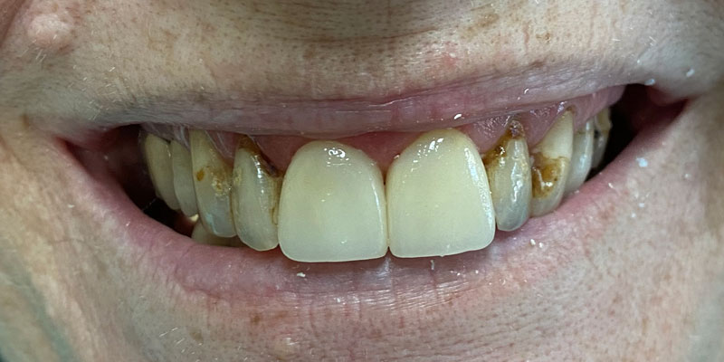 natural looking cosmetic crowns